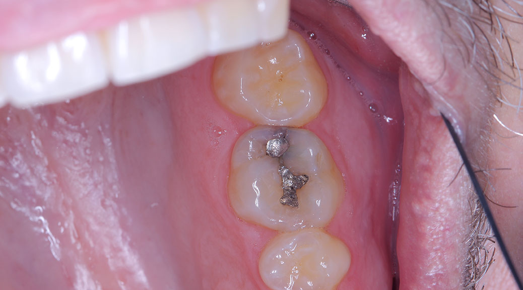 occlusal_featured